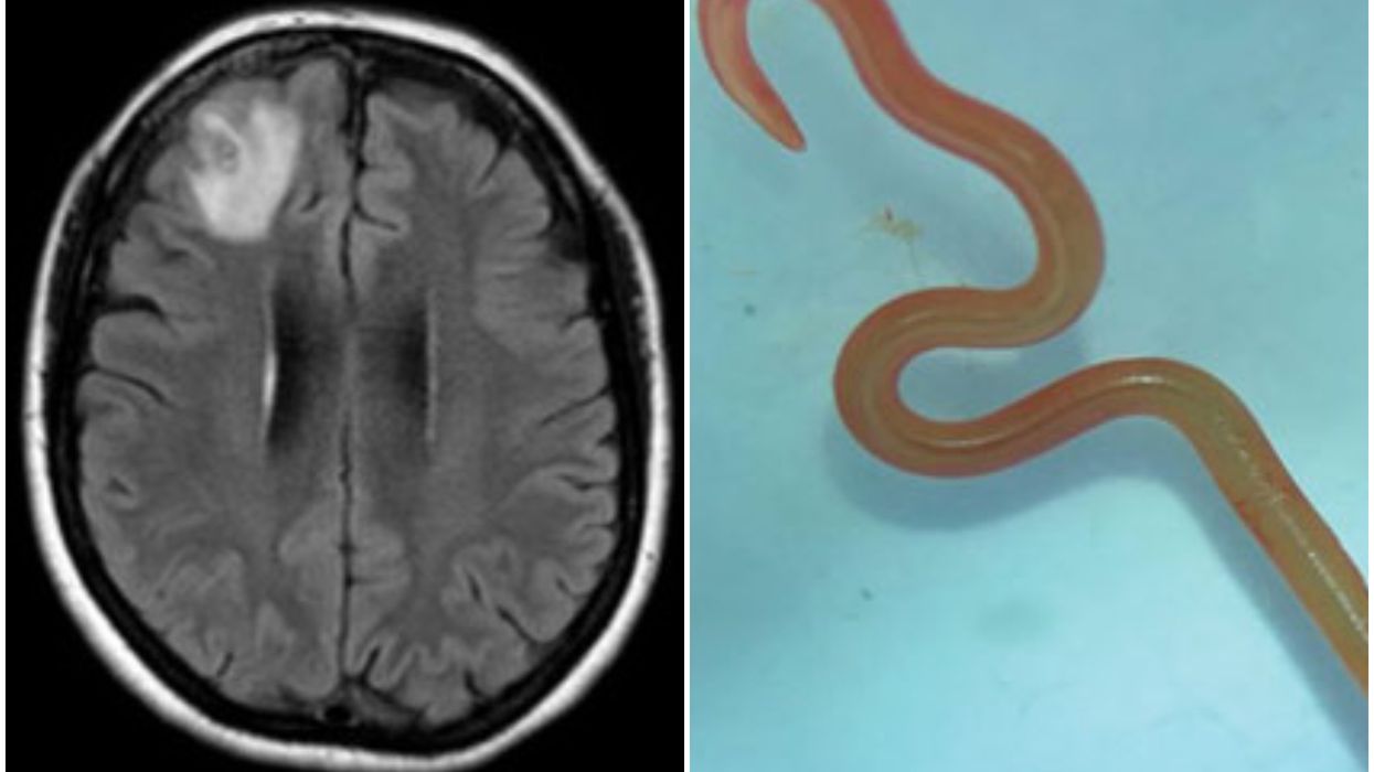 Live worm discovered in woman's brain in a worrying world first