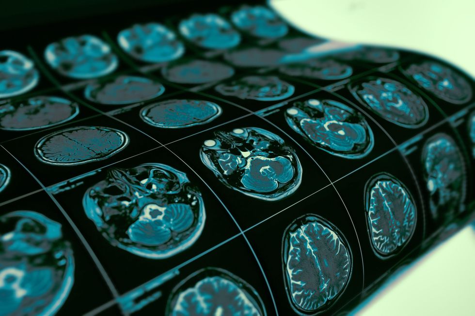 Doctor ‘brain cancer-free for a year’ after undergoing own breakthrough therapy