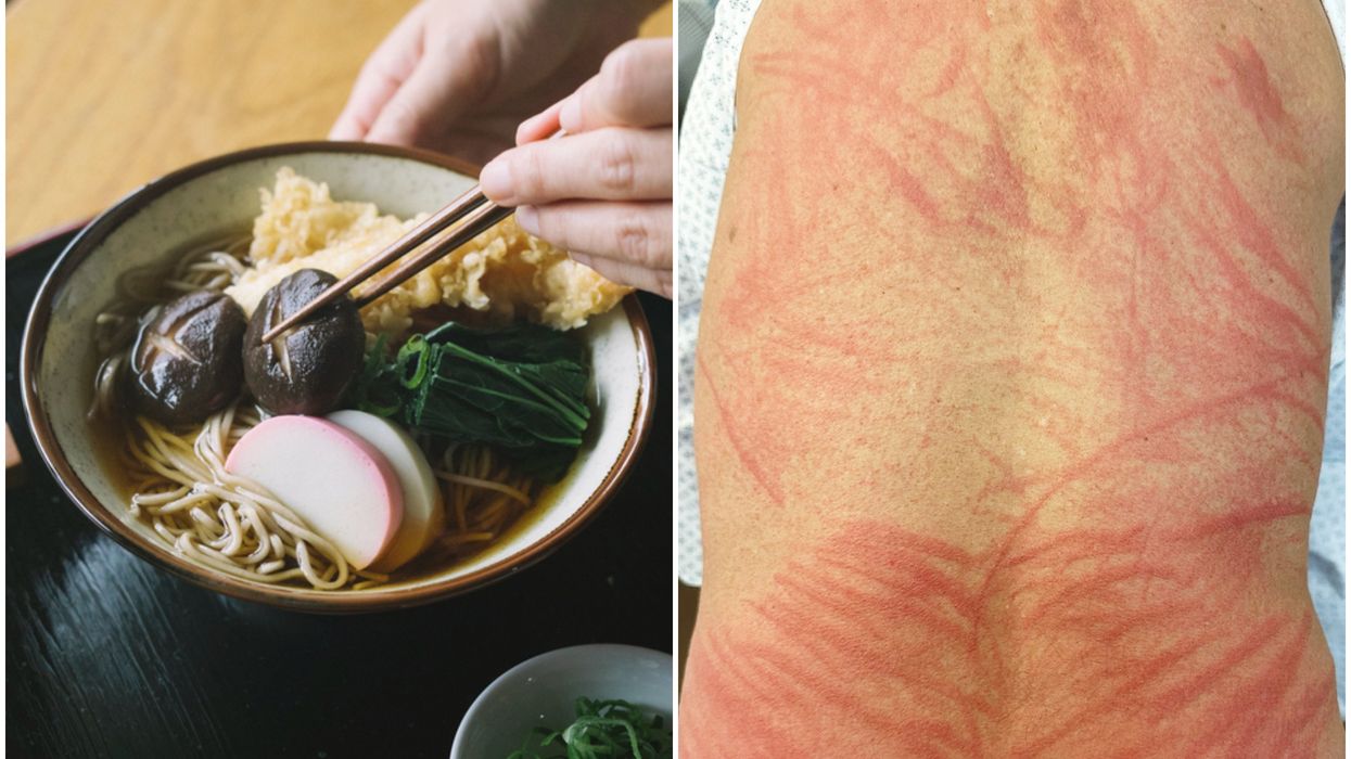 More and more people are suffering disturbing reactions to undercooked mushrooms