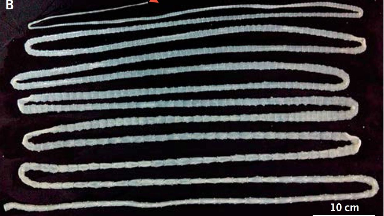 <p>A man discovered that tapeworms were the cause of his unexplained illnesses. </p>