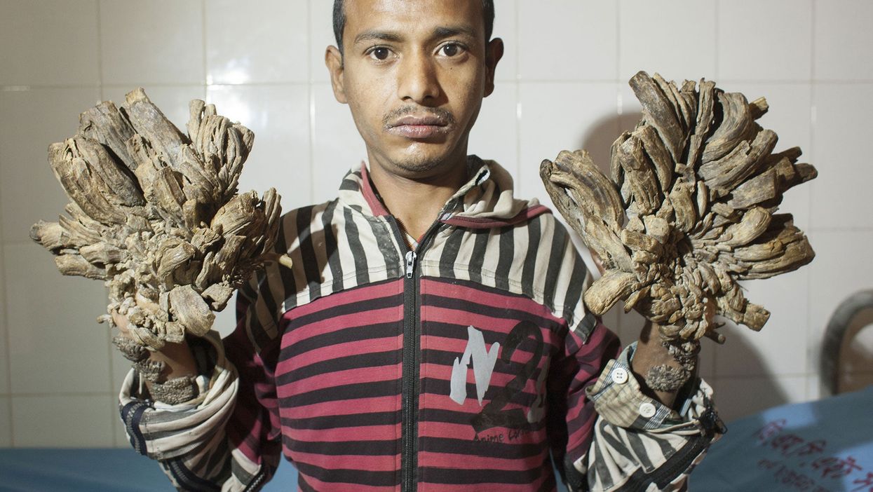 Abul Bajandar has been suffering from the condition for more than six years