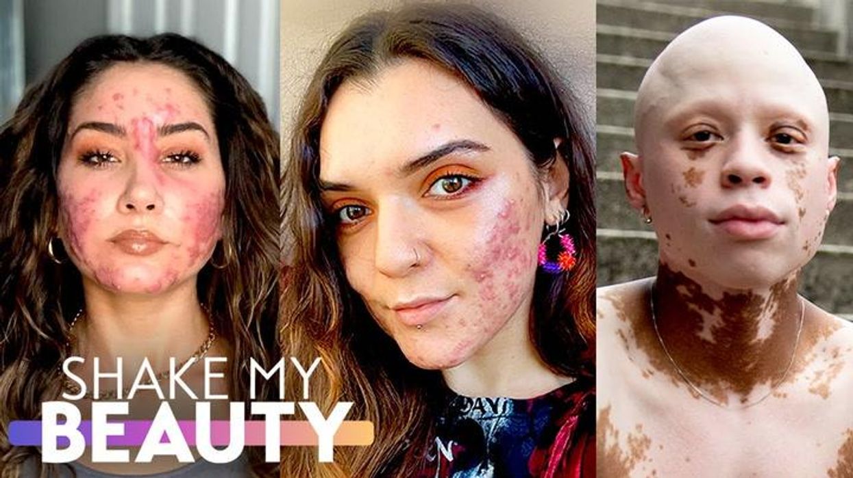 TikTok beauty queen says she was banned because of 'gruesome' acne