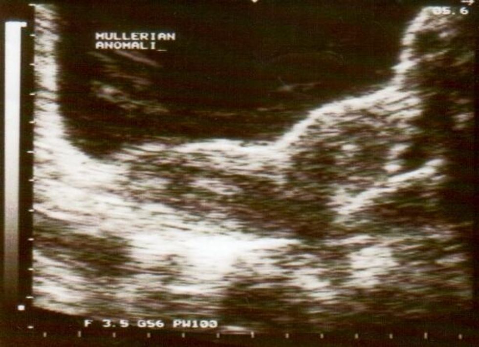 An Ultrasound showing didelphys. Picture: