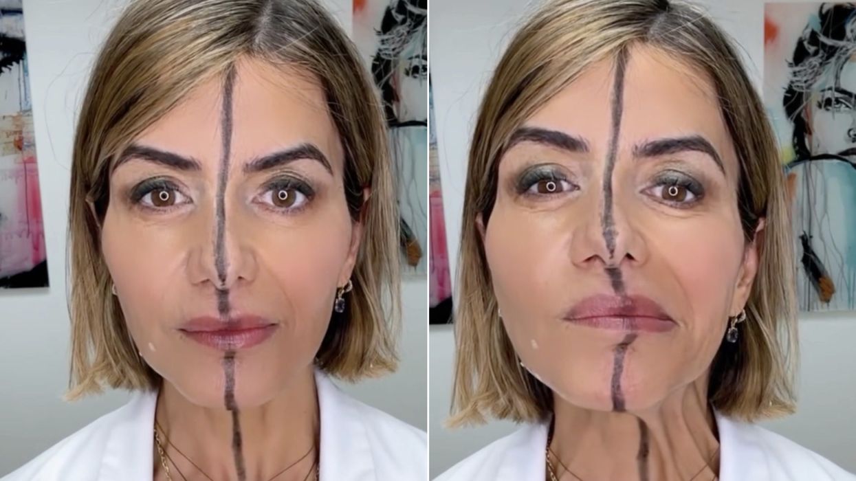 Woman injects just half of her face with botox to show exactly what it really does