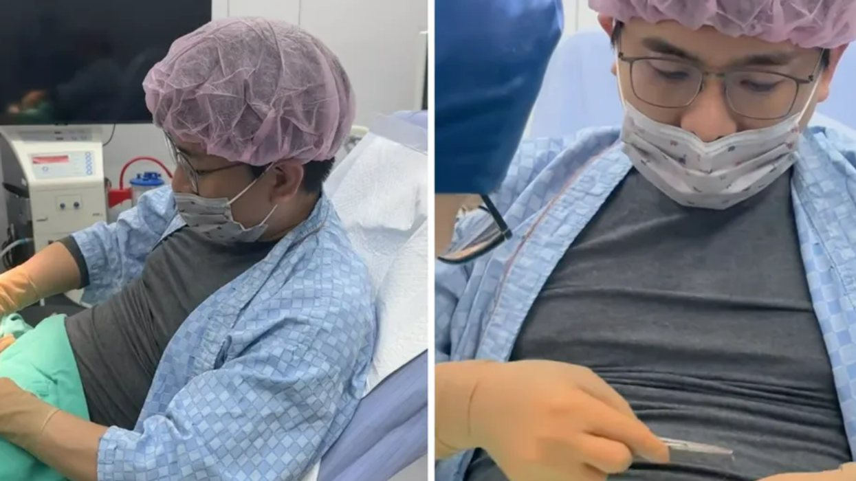 A surgeon performed a vasectomy on himself and posted the video on Instagram