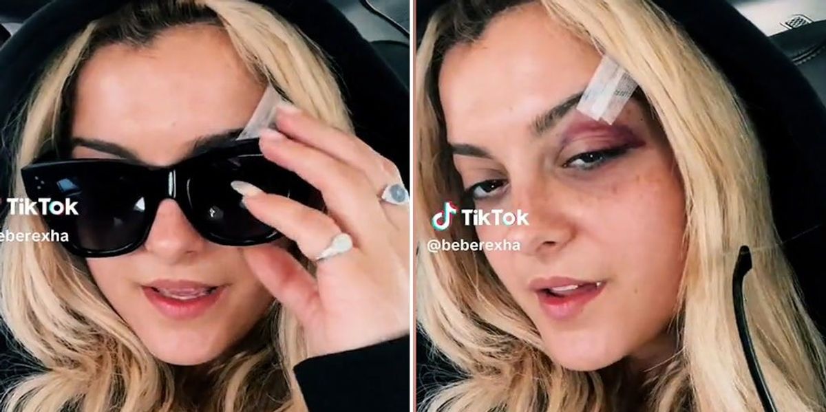 Bebe Rexha Shares Black Eye Update After Being Hit In Face By Phone bebe-rexha-shares-black-eye-update-after-being-hit-in-face-by-phone