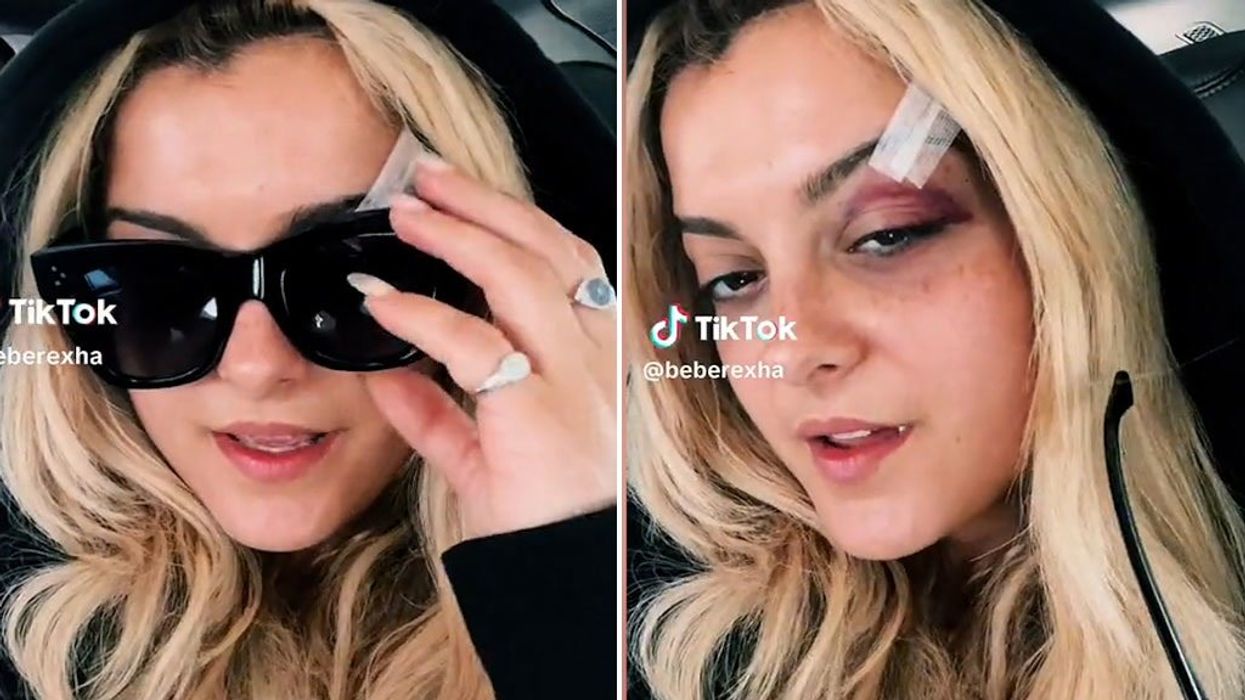 Bebe Rexha shares black eye update after being hit in face by phone during concert