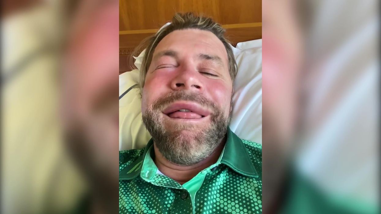 Brian McFadden shares surreal allergic reaction to bee sting