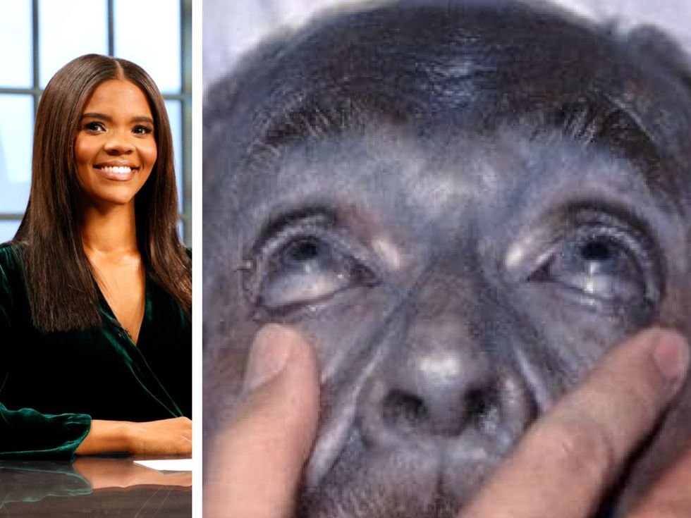 <p>Candace Owens (L) and a patient with argyria (R)</p>