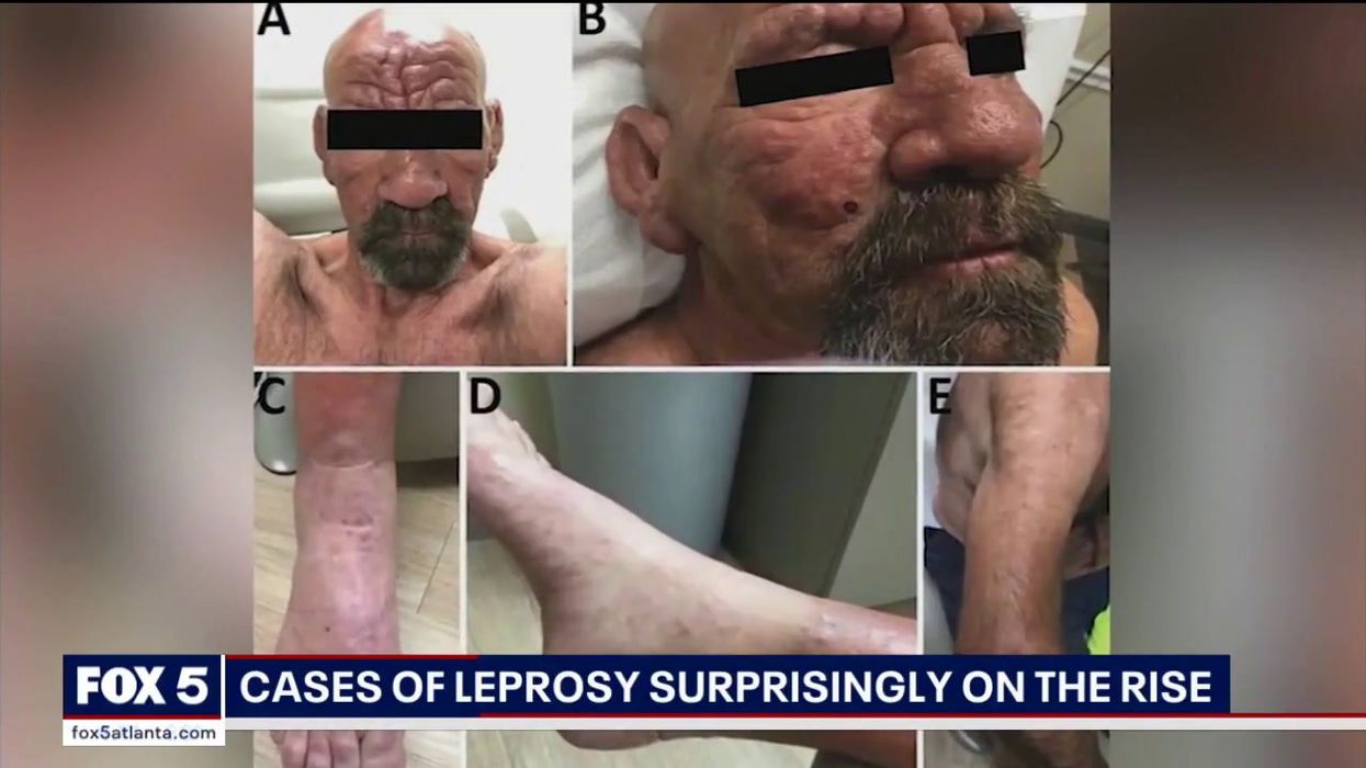 Leprosy cases are dramatically rising in the US
