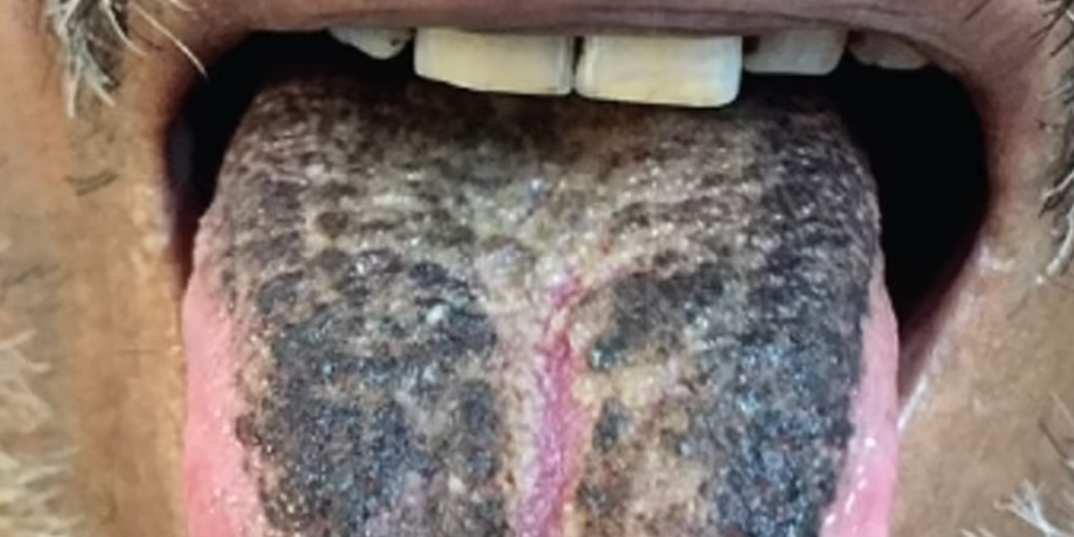 Black hair on clearance tongue