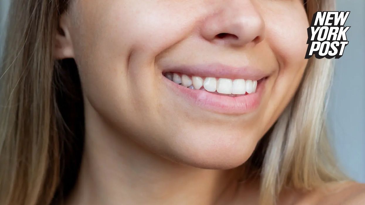 Millions of people are discovering they have a facial feature that makes them a 'mutant'