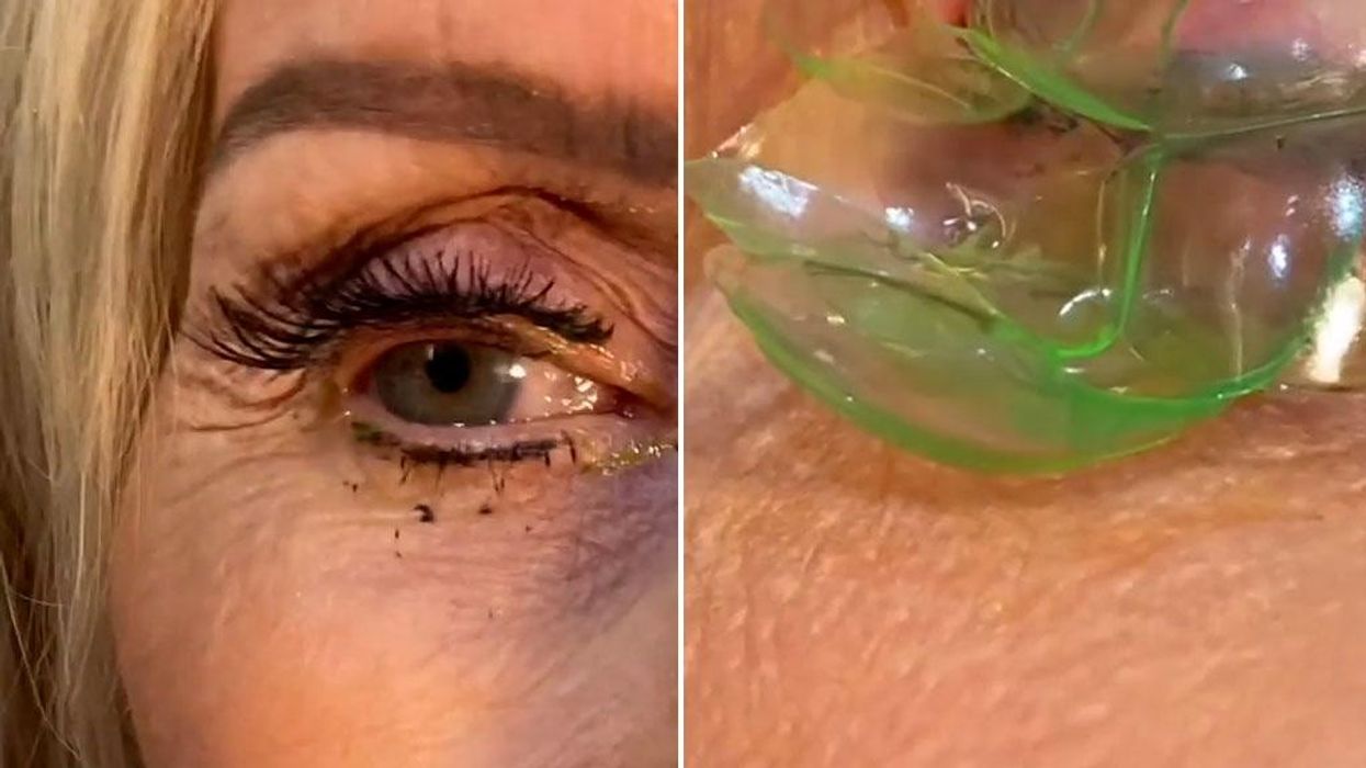 Woman ends up in hospital after mistaking super glue for eye drops