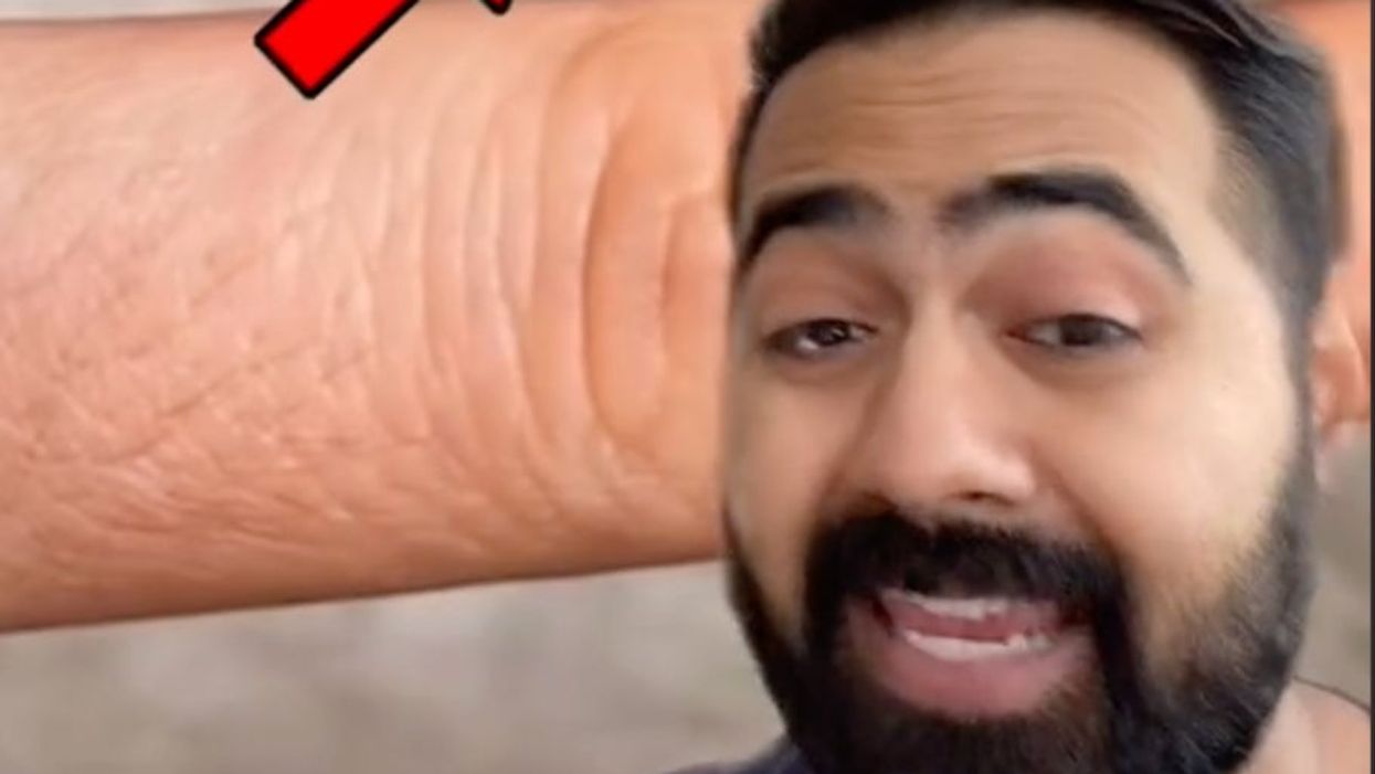 <p>Dr Karan Raj reviews whether a ‘pinch trick’ can tell you if you’re dehydrated</p>