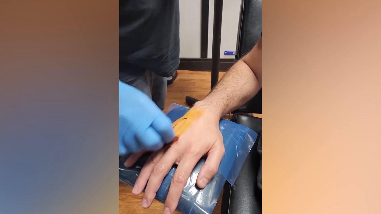 Man gets car key chip inserted into in his hand so he never loses it