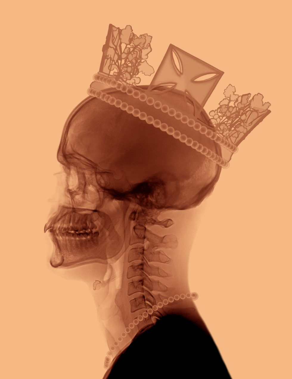 Ernesto Romano's X-Ray Queen