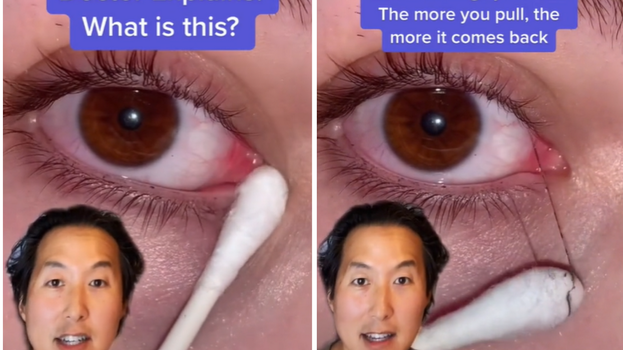 Experts warn against 'fishing' mucus out of your eyes as seen on TikTok