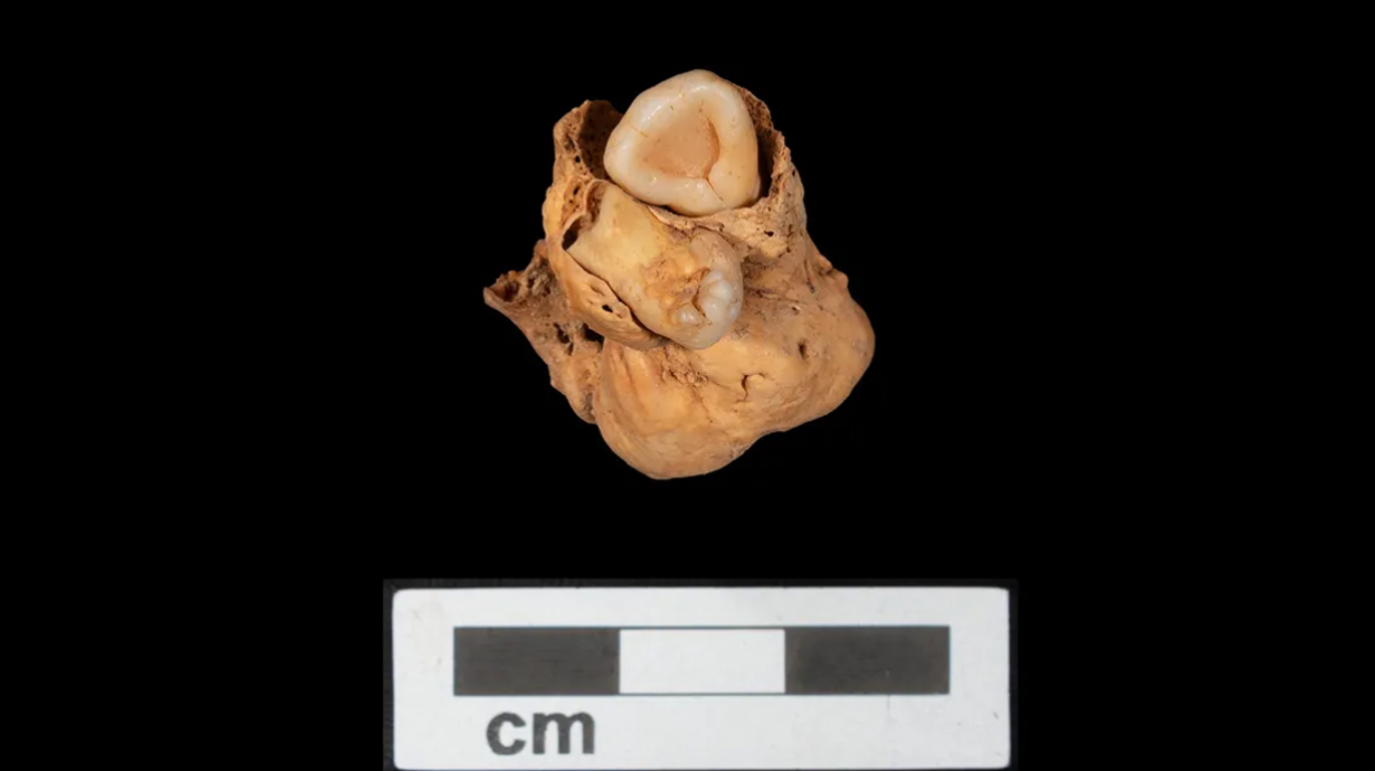 Creepy 3000-year-old tumour 'with teeth' found in ancient burial site