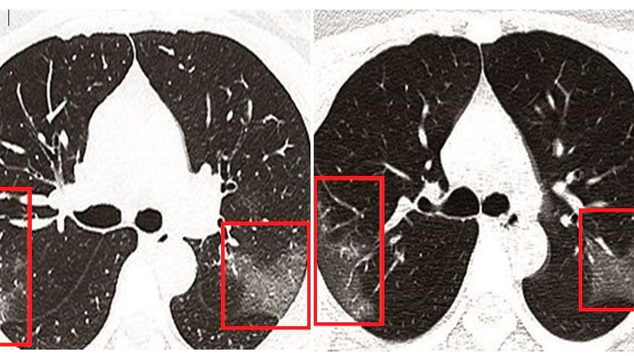 X-ray reveals the terrifying effects of coronavirus on human lungs