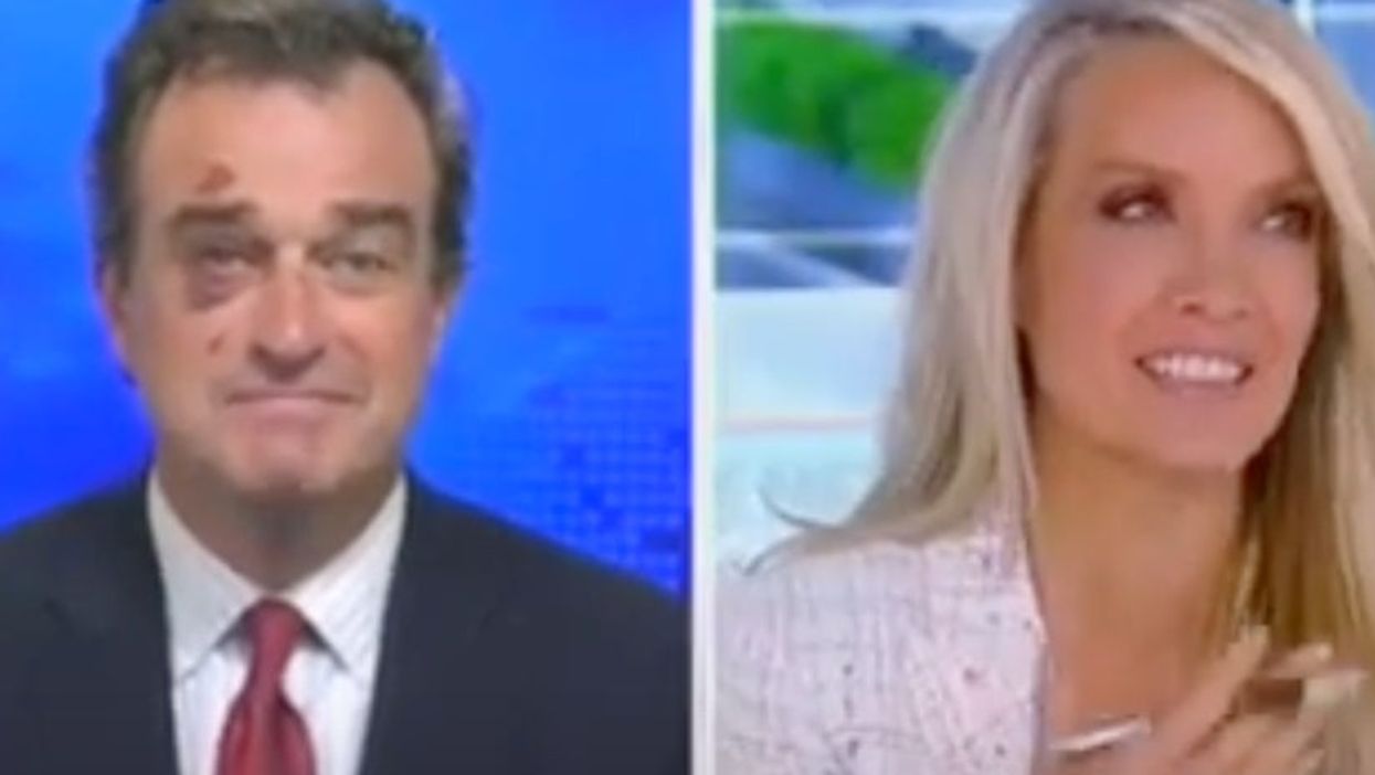 Fox News contributor bizarrely blames bruised face on headbutting contest with a horse