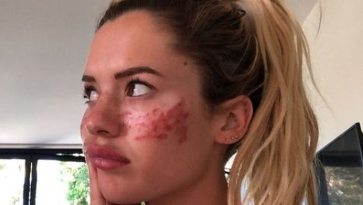 Reality star says she tried to give herself freckles with needles and ink - and ended up in hospital