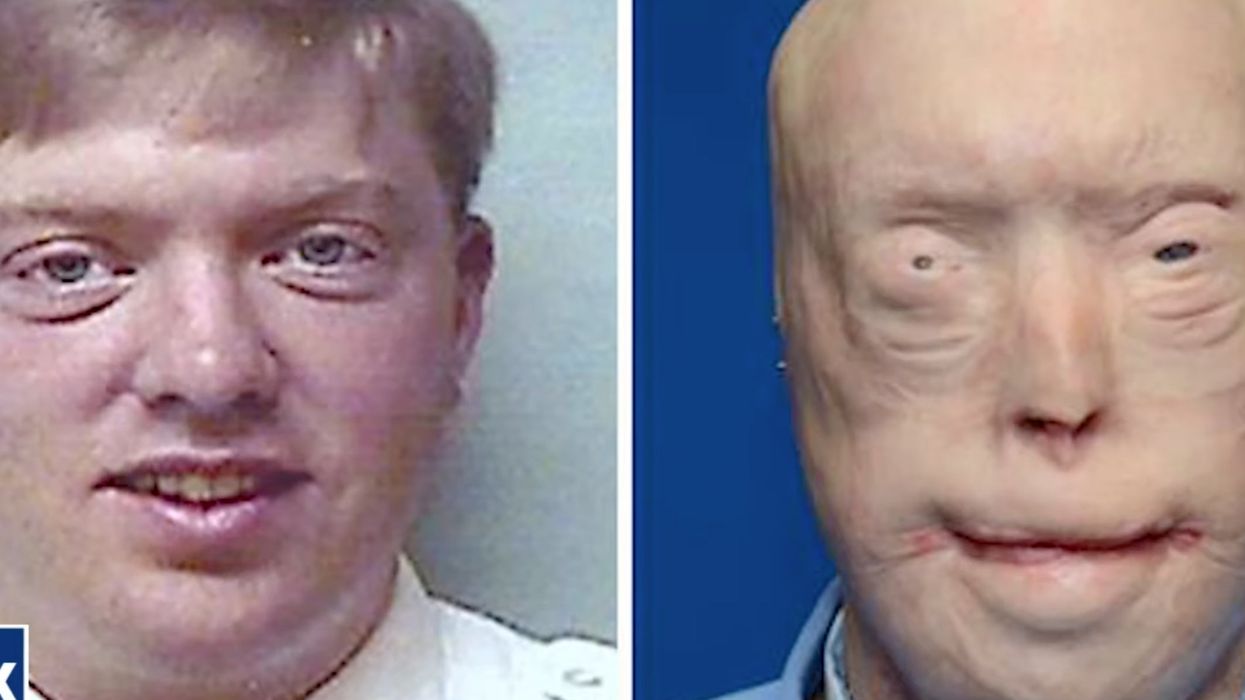 Man who had the world’s most extensive face transplant operation reveals how his life has changed