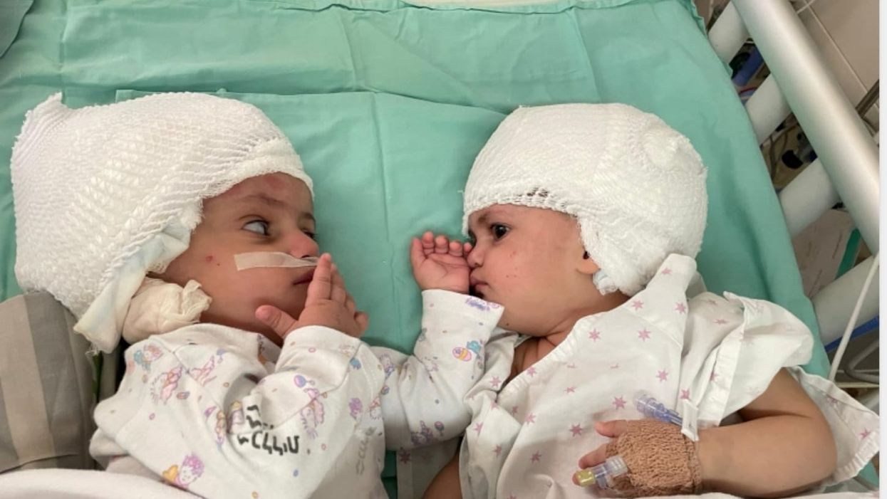 Twins conjoined at the head separated after rare successful surgery in Israel