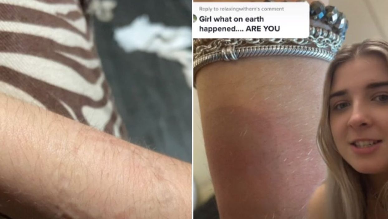Woman who passed out on night out later discovered bite mark on arm