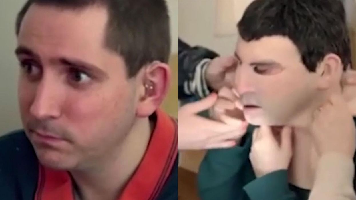 Man allergic to the sun gets replica mask of his own face