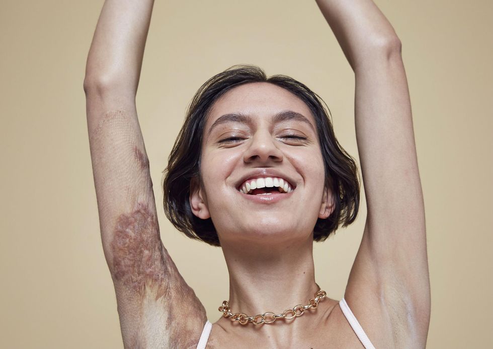 New Beauty Campaign By Missguided Celebrates Scars Birth Marks And Skin Conditions Indy100