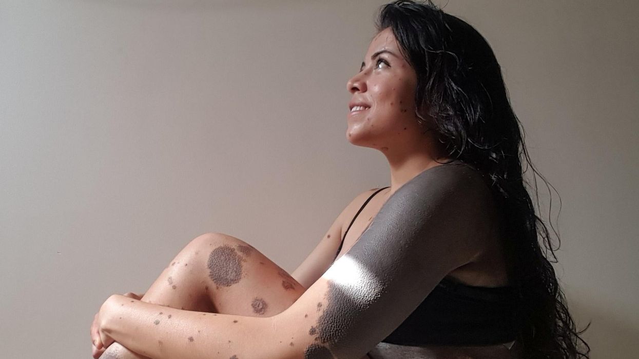 Woman with large birthmarks all over her body strips off to make important point about body positivity