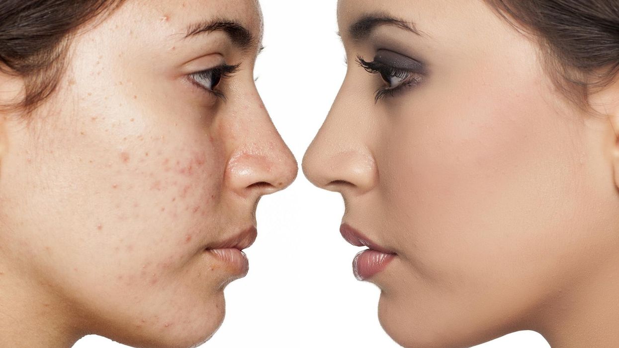 Why the beauty industry will never fully embrace spots, scars and pimples