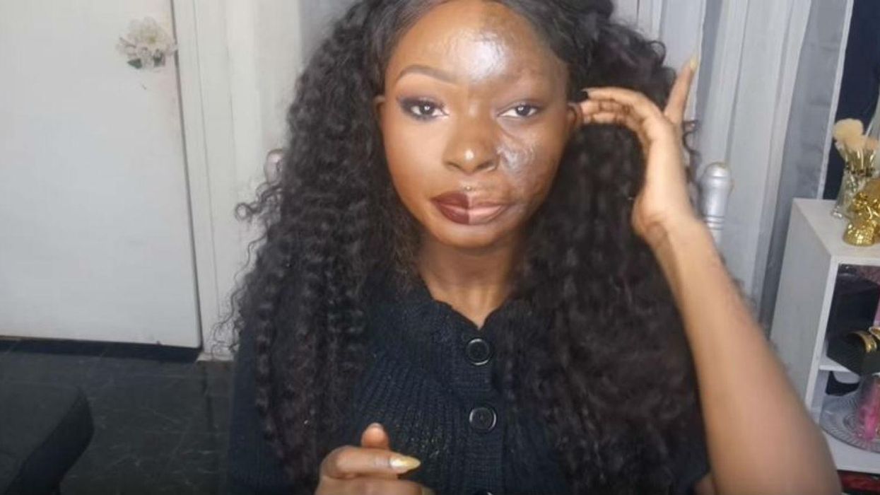 Burns survivor only did half her makeup to show what real beauty looks like