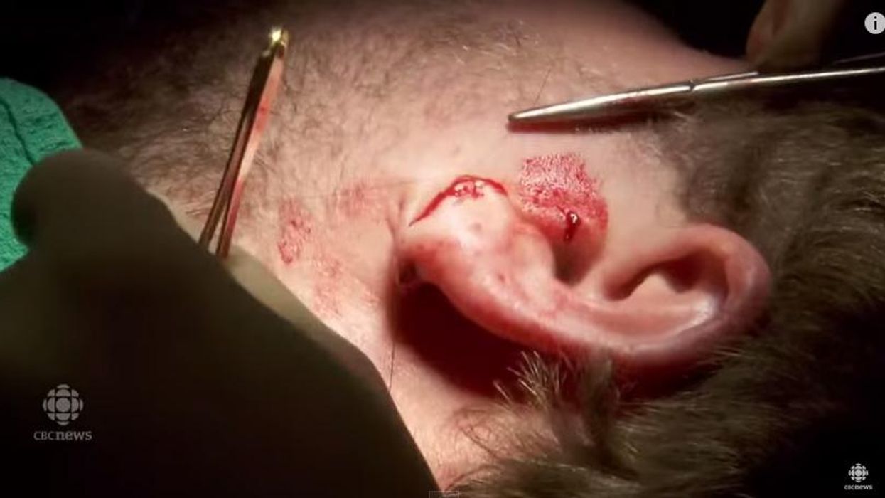 Watch this man get reconstructive surgery on his earlobes, if you dare