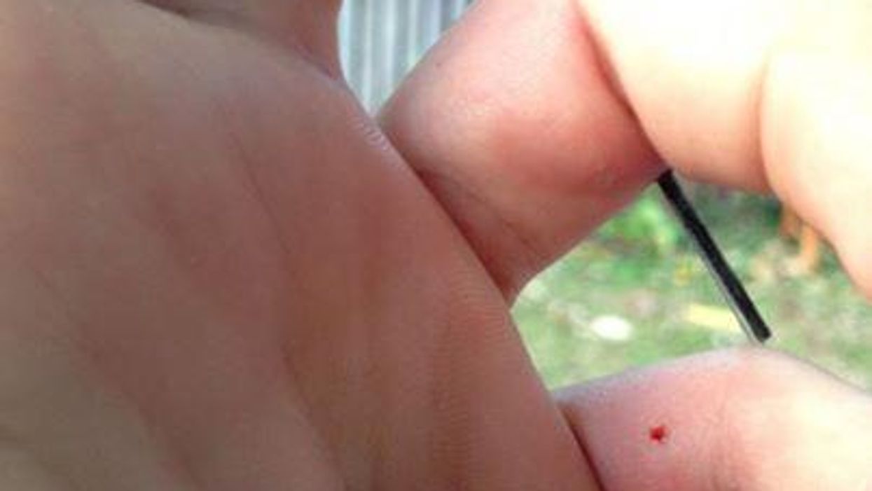 A piece of fibreglass went right through this man's finger