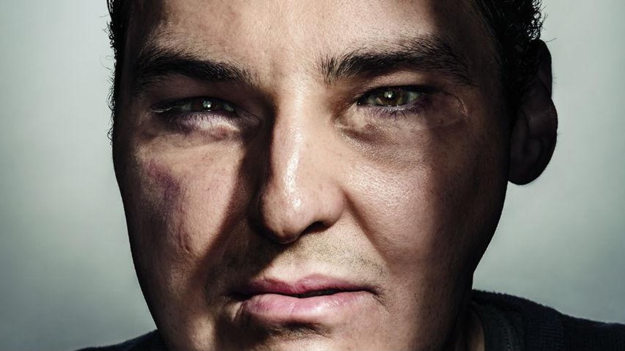How Richard Lee Norris went from face transplant patient to cover star