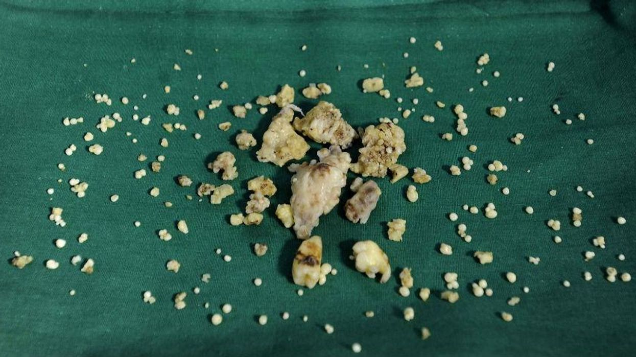 Indian boy has 232 teeth removed from his mouth (really)