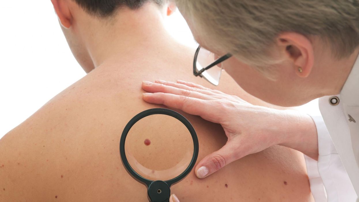 These are the skin cancer warning signs you should never ignore