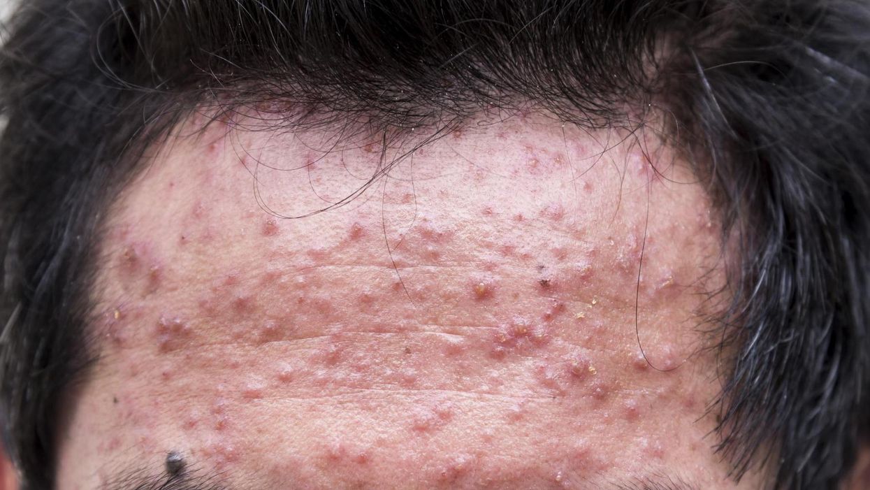 One surprising upside to bad skin