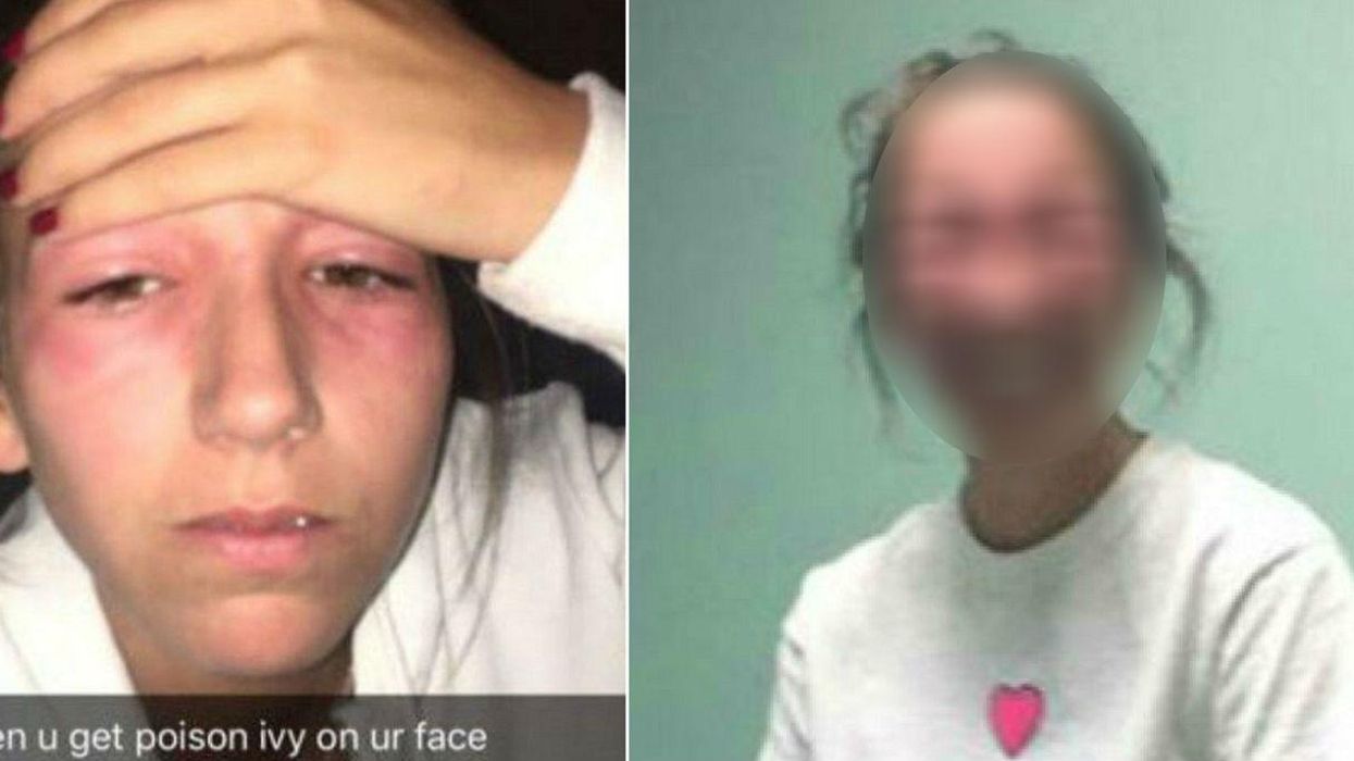 Let this young woman who got poison ivy in her eyes be a lesson to all of us