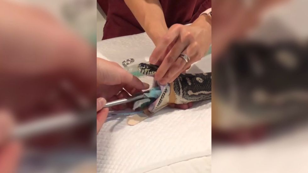 Doctors remove entire beach towel from python with their hands
