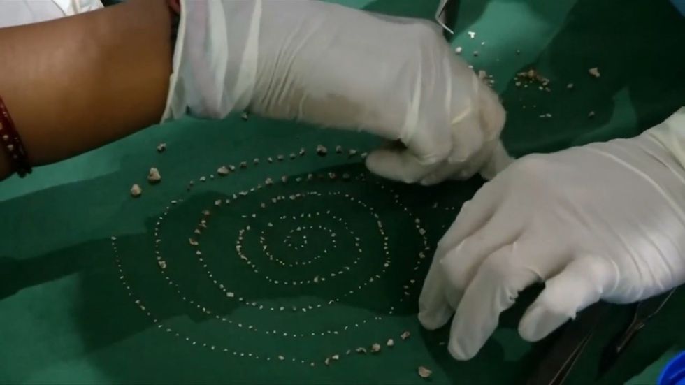 526 teeth removed from mouth of boy with rare medical condition