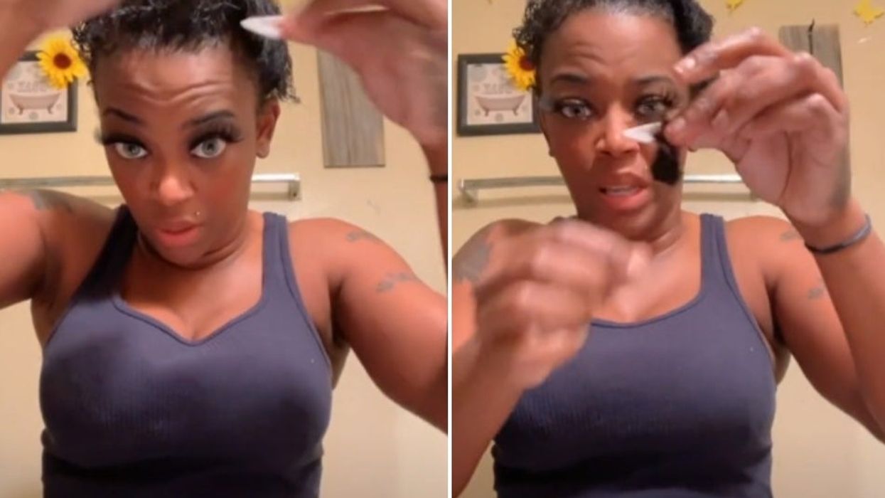 Woman who glued her hair to her head is now losing it because of botched dye job