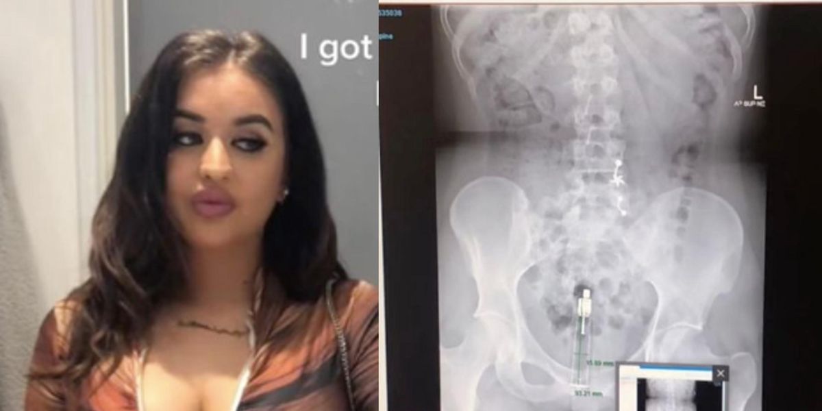Stuck Up X Rays Woman has to have surgery after sex toy gets stuck inside her | indy100