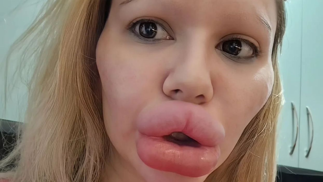 Influencer with 'world's biggest lips' warned they will burst if she has more filler