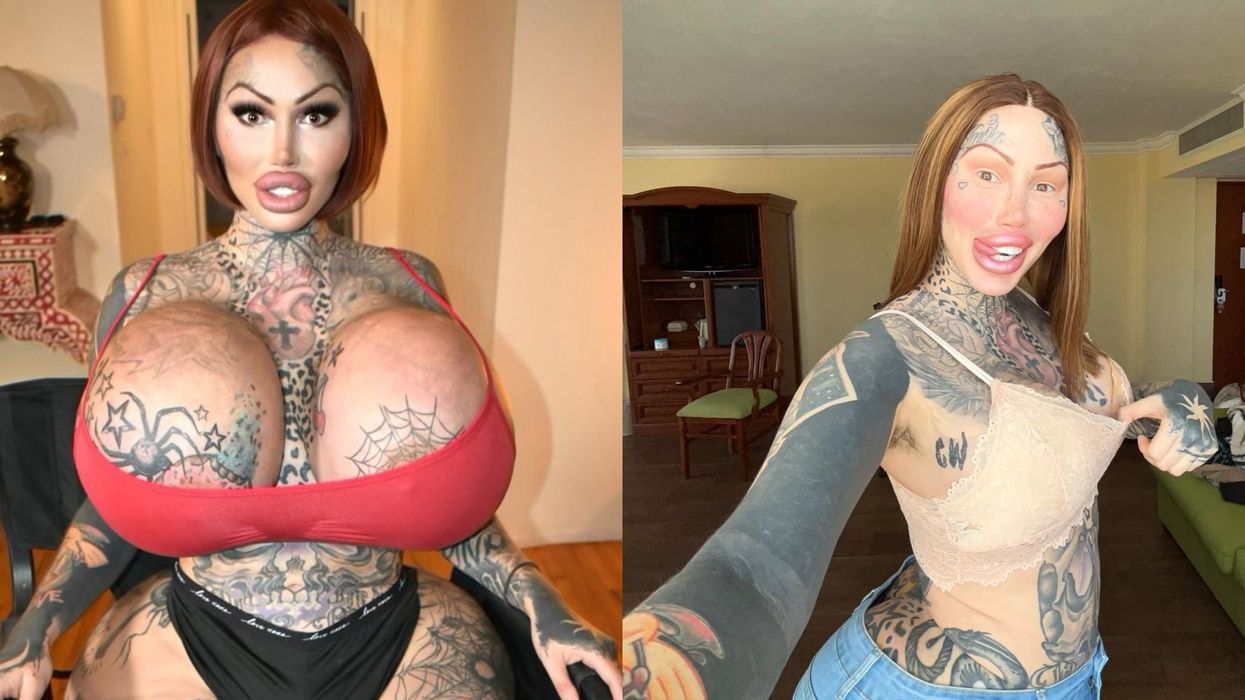 'Surgery addicted' model told she looks happier and healthier after losing 38J implants