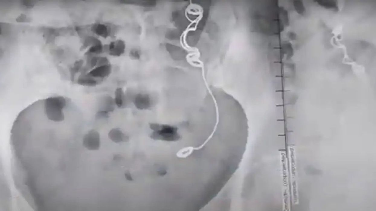 Woman who was in pain for more than a decade discovers needle and thread inside her