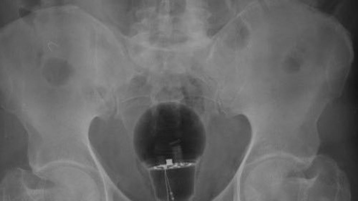 X-rays discover lightbulb in patient's bottom