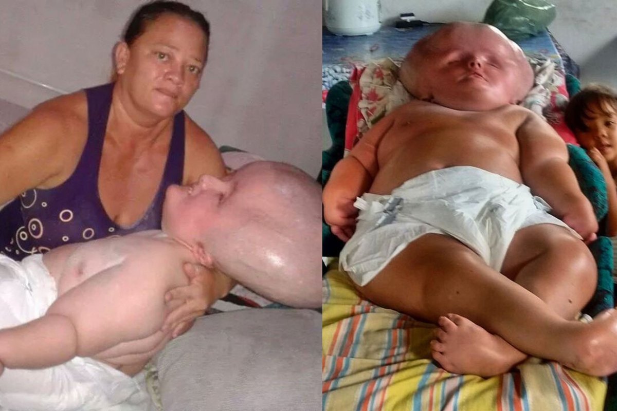 'My daughter's head wouldn't stop growing – people call her names but I think she's beautiful'