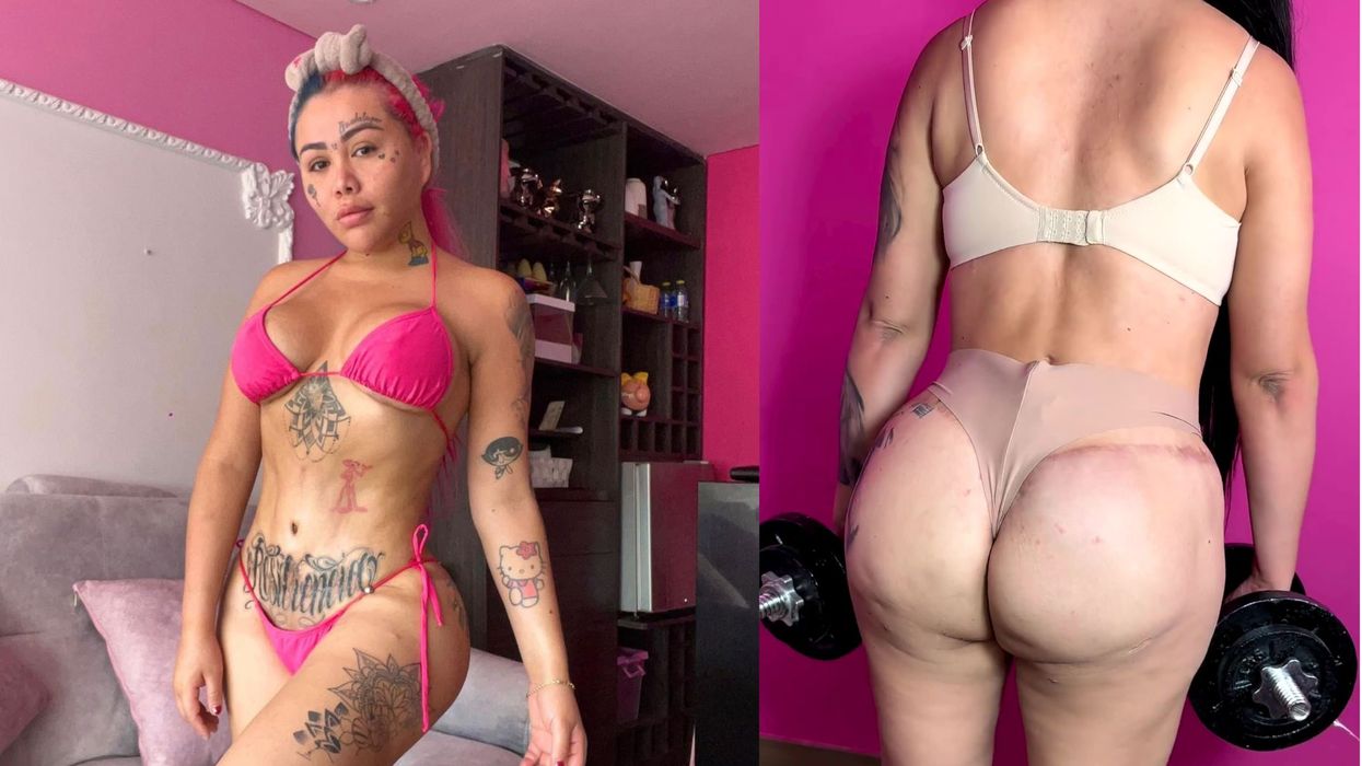 Influencer left with implant bulging out of her bum following botched surgery
